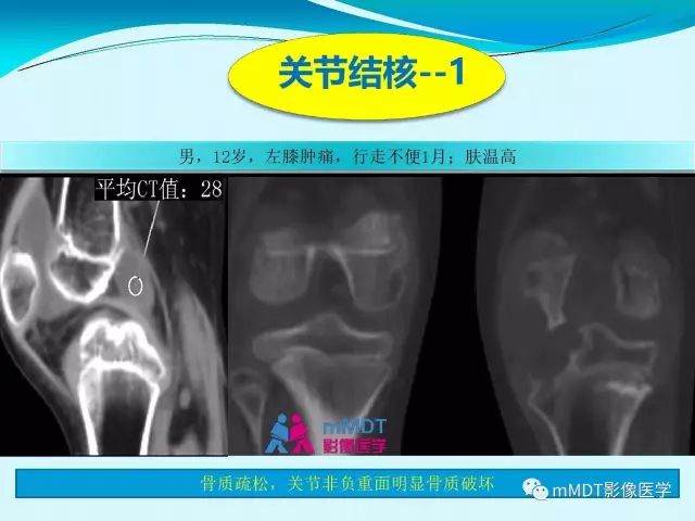 【PPT】膝关节色素沉着绒毛结节性滑膜炎影像表现PVNS