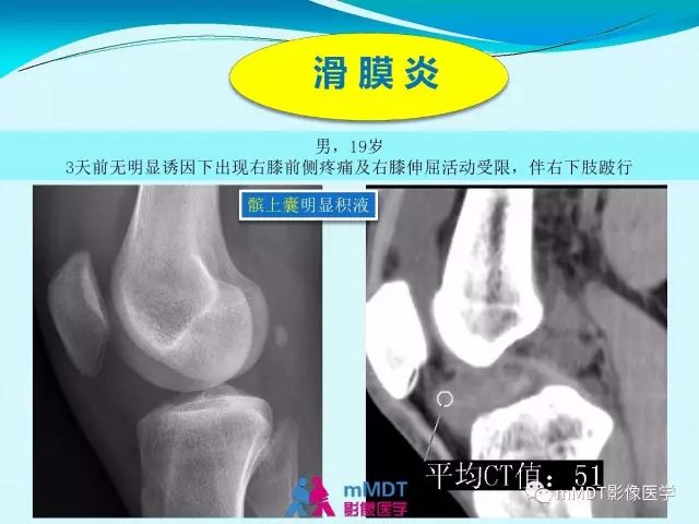 【PPT】膝关节色素沉着绒毛结节性滑膜炎影像表现PVNS