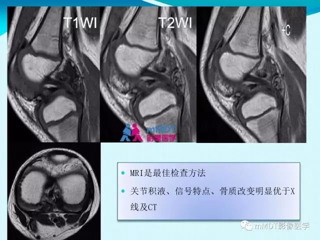 【PPT】膝关节色素沉着绒毛结节性滑膜炎影像表现PVNS