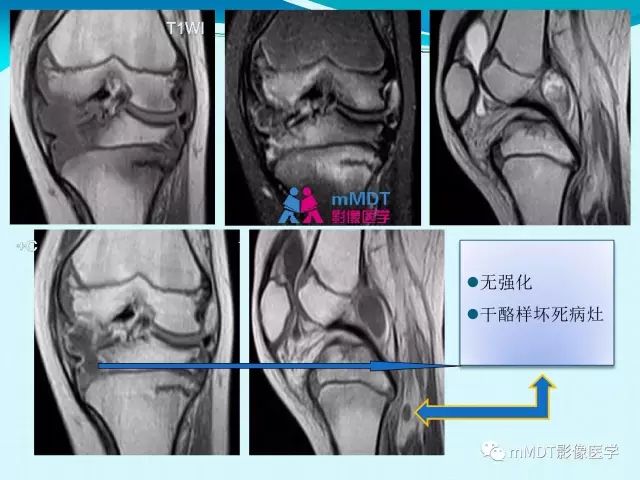 【PPT】膝关节色素沉着绒毛结节性滑膜炎影像表现PVNS