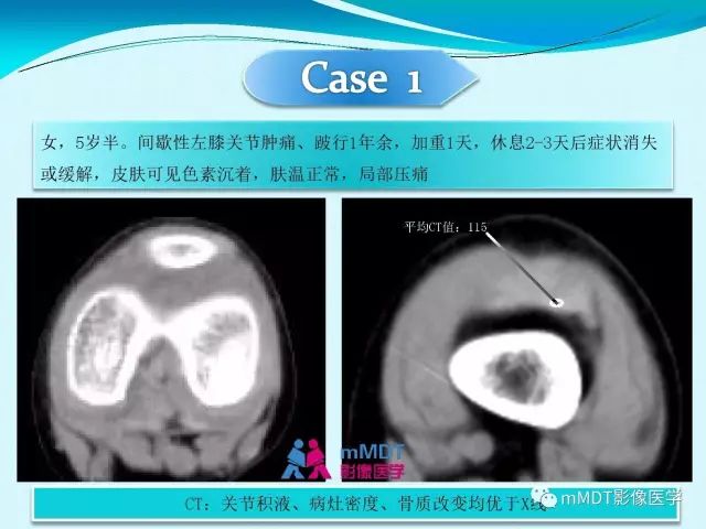 【PPT】膝关节色素沉着绒毛结节性滑膜炎影像表现PVNS