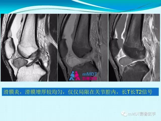【PPT】膝关节色素沉着绒毛结节性滑膜炎影像表现PVNS