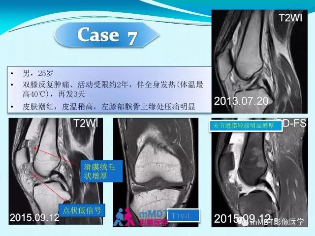 【PPT】膝关节色素沉着绒毛结节性滑膜炎影像表现PVNS