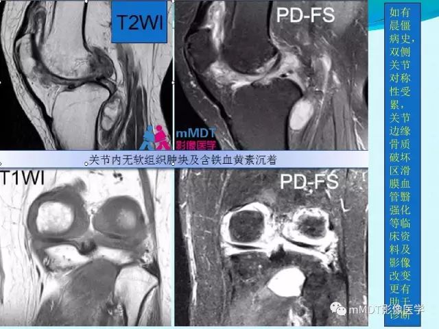 【PPT】膝关节色素沉着绒毛结节性滑膜炎影像表现PVNS
