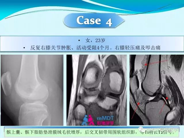 【PPT】膝关节色素沉着绒毛结节性滑膜炎影像表现PVNS