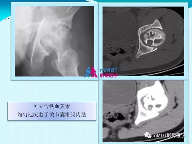 【PPT】膝关节色素沉着绒毛结节性滑膜炎影像表现PVNS
