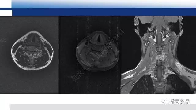 【PPT】脊柱良性肿瘤及肿瘤样病变影像诊断