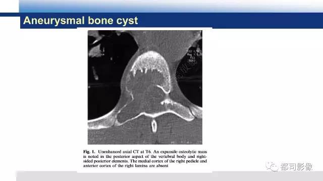 【PPT】脊柱良性肿瘤及肿瘤样病变影像诊断