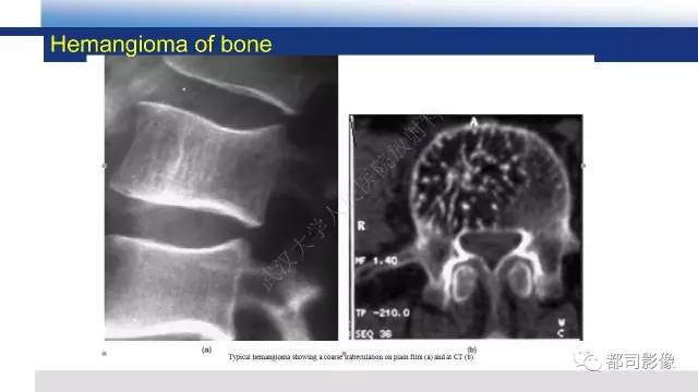 【PPT】脊柱良性肿瘤及肿瘤样病变影像诊断