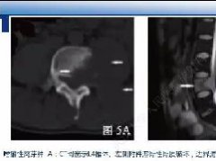 脊柱良性肿瘤及肿瘤样病变影像诊断