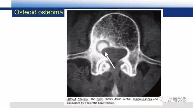 【PPT】脊柱良性肿瘤及肿瘤样病变影像诊断