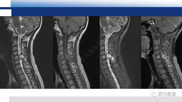 【PPT】脊柱良性肿瘤及肿瘤样病变影像诊断
