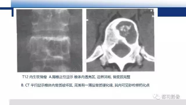 【PPT】脊柱良性肿瘤及肿瘤样病变影像诊断