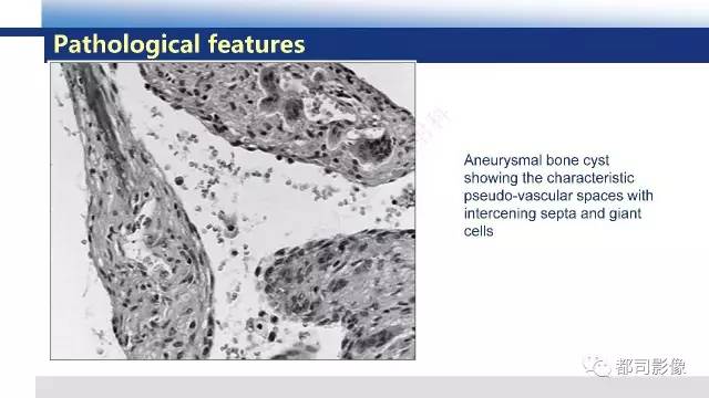 【PPT】脊柱良性肿瘤及肿瘤样病变影像诊断