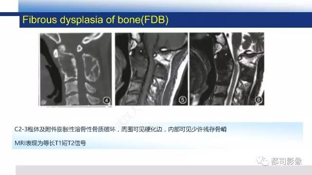 【PPT】脊柱良性肿瘤及肿瘤样病变影像诊断