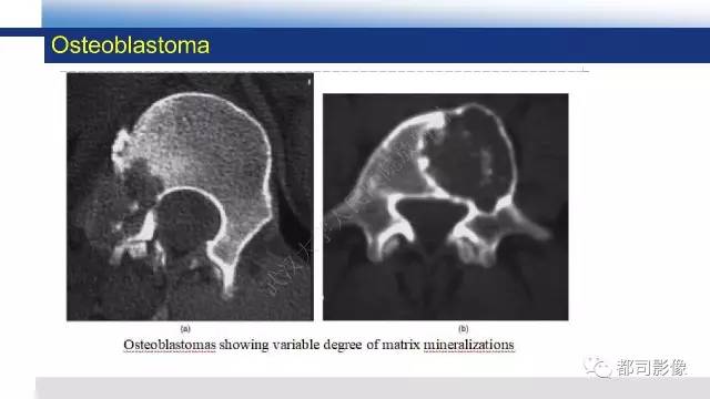 【PPT】脊柱良性肿瘤及肿瘤样病变影像诊断