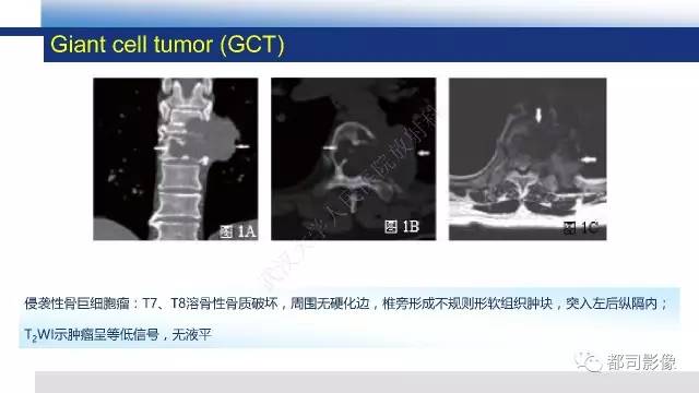 【PPT】脊柱良性肿瘤及肿瘤样病变影像诊断