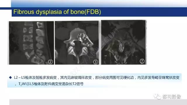 【PPT】脊柱良性肿瘤及肿瘤样病变影像诊断