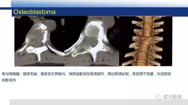 【PPT】脊柱良性肿瘤及肿瘤样病变影像诊断