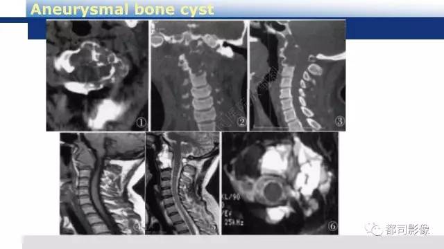 【PPT】脊柱良性肿瘤及肿瘤样病变影像诊断