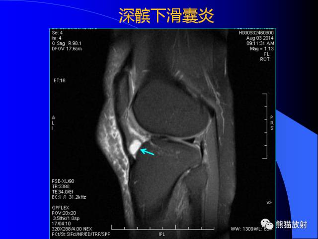 【PPT】膝关节周围囊肿MRI 【PPT】膝关节周围囊肿MRI