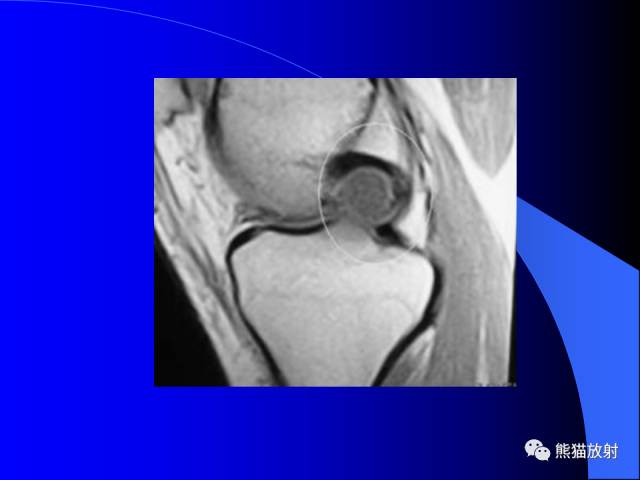 【PPT】膝关节周围囊肿MRI 【PPT】膝关节周围囊肿MRI