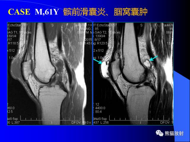 【PPT】膝关节周围囊肿MRI 【PPT】膝关节周围囊肿MRI