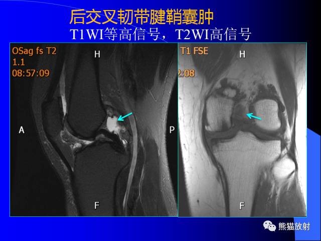 【PPT】膝关节周围囊肿MRI 【PPT】膝关节周围囊肿MRI