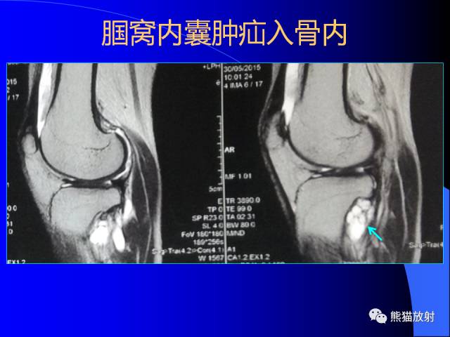 【PPT】膝关节周围囊肿MRI 【PPT】膝关节周围囊肿MRI