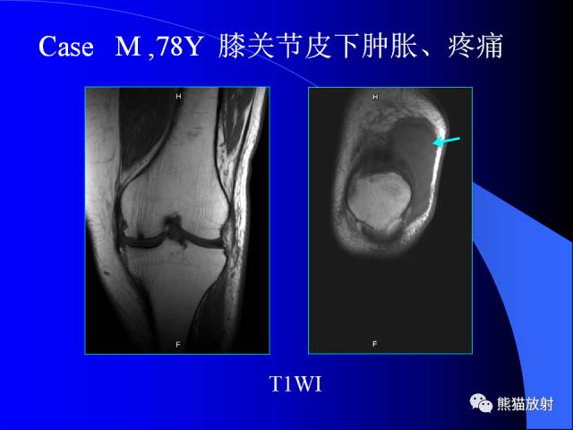 【PPT】膝关节周围囊肿MRI 【PPT】膝关节周围囊肿MRI