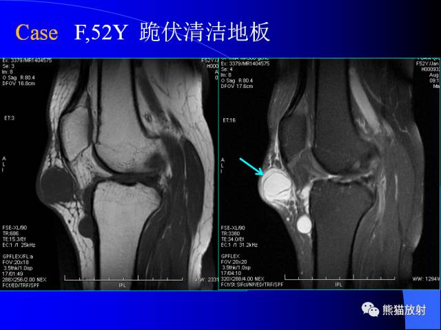 【PPT】膝关节周围囊肿MRI 【PPT】膝关节周围囊肿MRI