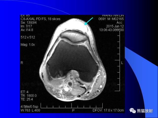 【PPT】膝关节周围囊肿MRI 【PPT】膝关节周围囊肿MRI