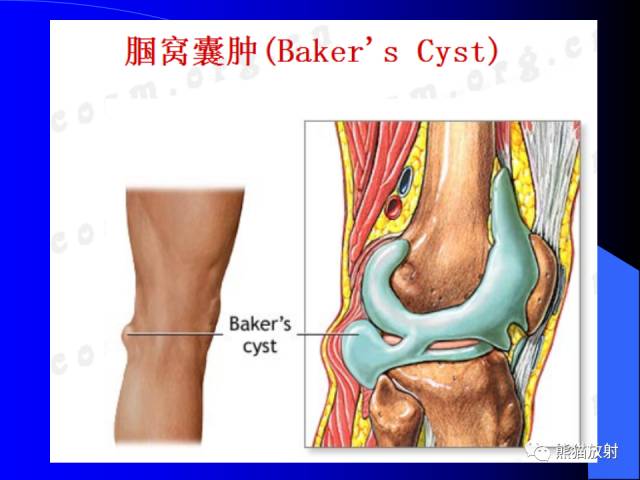 【PPT】膝关节周围囊肿MRI 【PPT】膝关节周围囊肿MRI