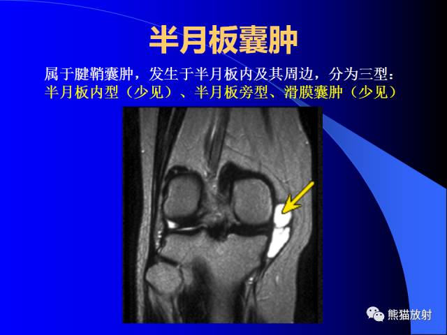 【PPT】膝关节周围囊肿MRI 【PPT】膝关节周围囊肿MRI