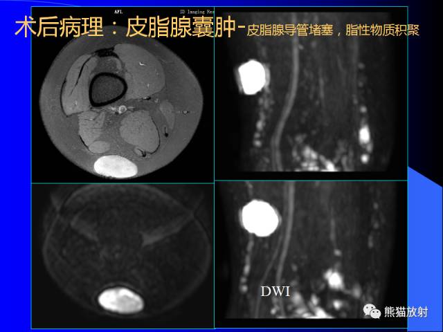 【PPT】膝关节周围囊肿MRI 【PPT】膝关节周围囊肿MRI