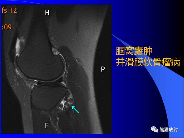 【PPT】膝关节周围囊肿MRI 【PPT】膝关节周围囊肿MRI