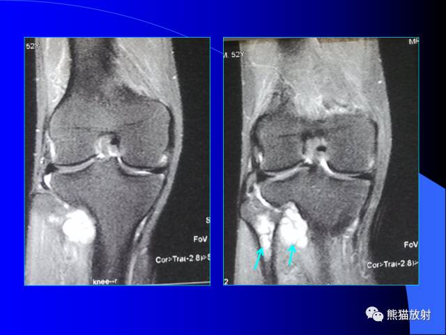 【PPT】膝关节周围囊肿MRI 【PPT】膝关节周围囊肿MRI
