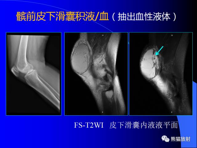 【PPT】膝关节周围囊肿MRI 【PPT】膝关节周围囊肿MRI
