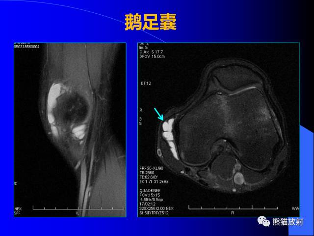 【PPT】膝关节周围囊肿MRI 【PPT】膝关节周围囊肿MRI