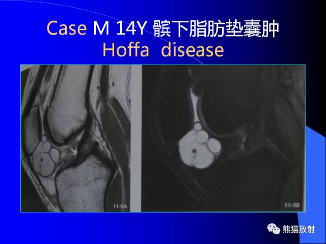 【PPT】膝关节周围囊肿MRI 【PPT】膝关节周围囊肿MRI