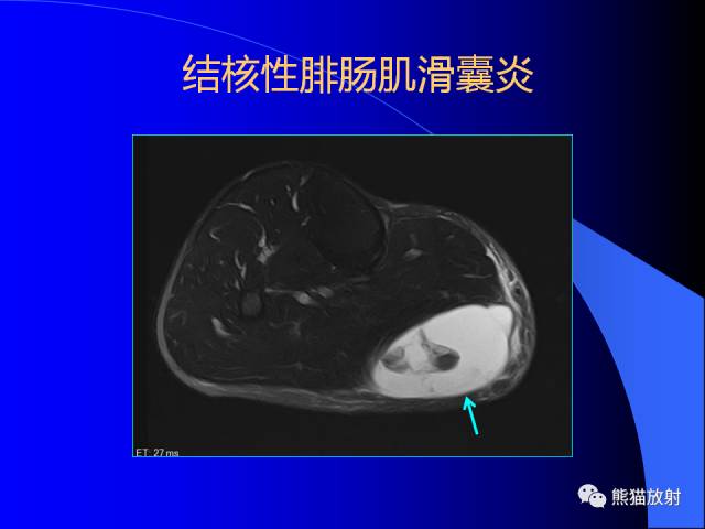 【PPT】膝关节周围囊肿MRI 【PPT】膝关节周围囊肿MRI