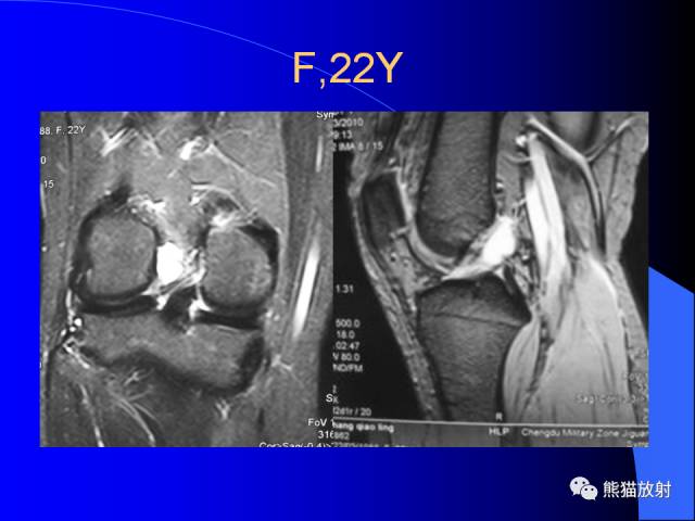 【PPT】膝关节周围囊肿MRI 【PPT】膝关节周围囊肿MRI