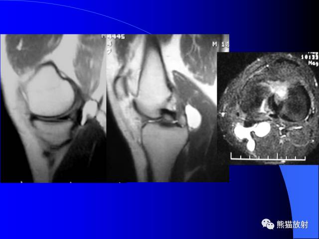 【PPT】膝关节周围囊肿MRI 【PPT】膝关节周围囊肿MRI