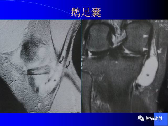 【PPT】膝关节周围囊肿MRI 【PPT】膝关节周围囊肿MRI