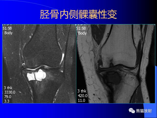 【PPT】膝关节周围囊肿MRI 【PPT】膝关节周围囊肿MRI