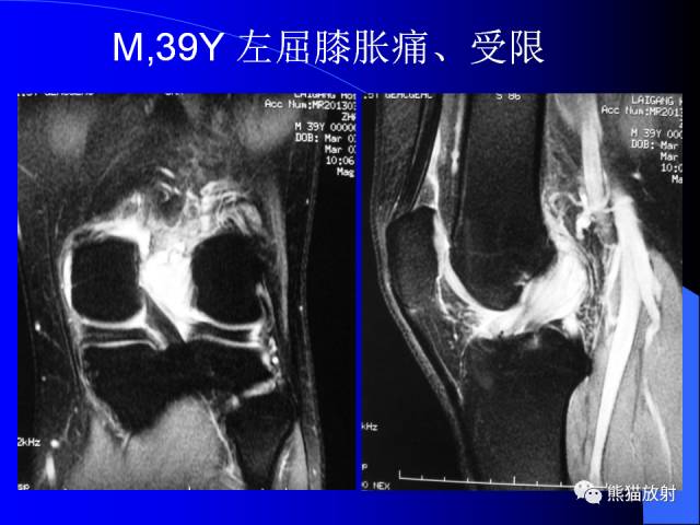 【PPT】膝关节周围囊肿MRI 【PPT】膝关节周围囊肿MRI