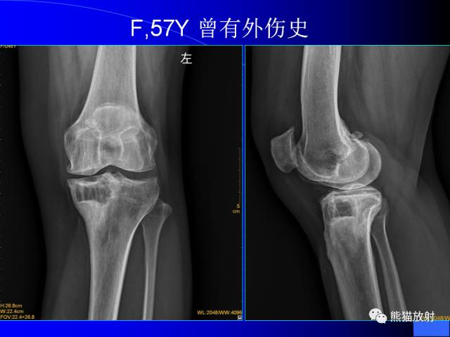 【PPT】膝关节周围囊肿MRI 【PPT】膝关节周围囊肿MRI