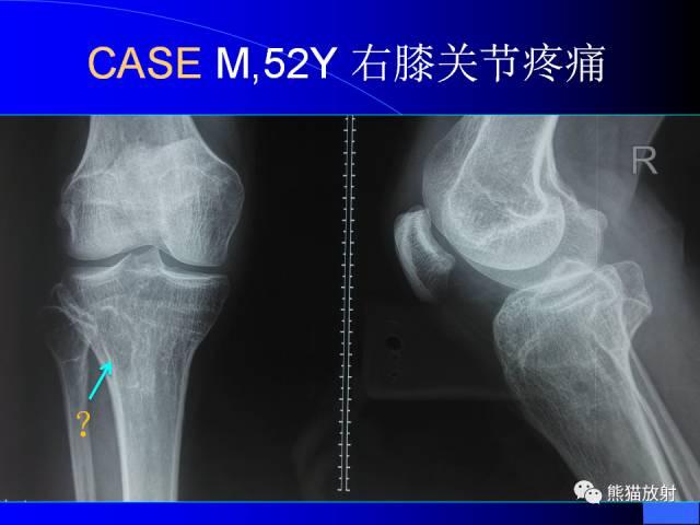 【PPT】膝关节周围囊肿MRI 【PPT】膝关节周围囊肿MRI