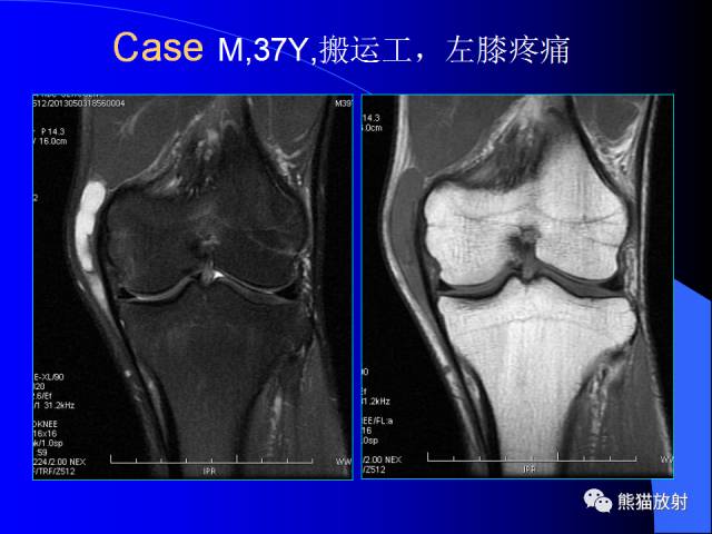 【PPT】膝关节周围囊肿MRI 【PPT】膝关节周围囊肿MRI