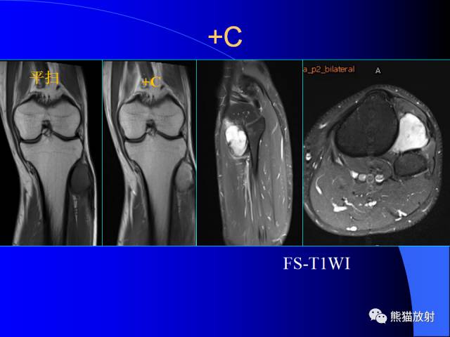 【PPT】膝关节周围囊肿MRI 【PPT】膝关节周围囊肿MRI